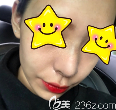 感受下韓國博朗溫金貴洛3DCT鼻整形，這就是別人家的好