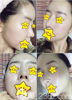 金貴洛鼻整形真人案例 金貴洛鼻整形真人案例