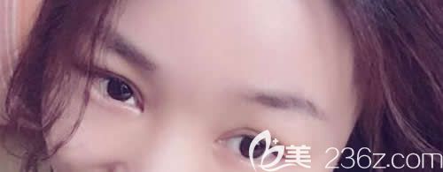 我在吉安天使整形做仿生無痕雙眼皮術(shù)后第6天效果 我在吉安天使整形做仿生無痕雙眼皮術(shù)后第6天效果