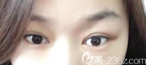 吉安天使整形袁寶玉院長給我做仿生無痕雙眼皮術(shù)后第18天恢復(fù)效果 吉安天使整形袁寶玉院長給我做仿生無痕雙眼皮術(shù)后第18天恢復(fù)效果