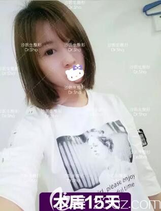 在大連沙醫(yī)生整形做完眼綜合術(shù)后半個月效果