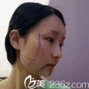 韓國佳輪韓整形醫(yī)院輪廓三件套真人案例 韓國佳輪韓整形醫(yī)院輪廓三件套真人案例