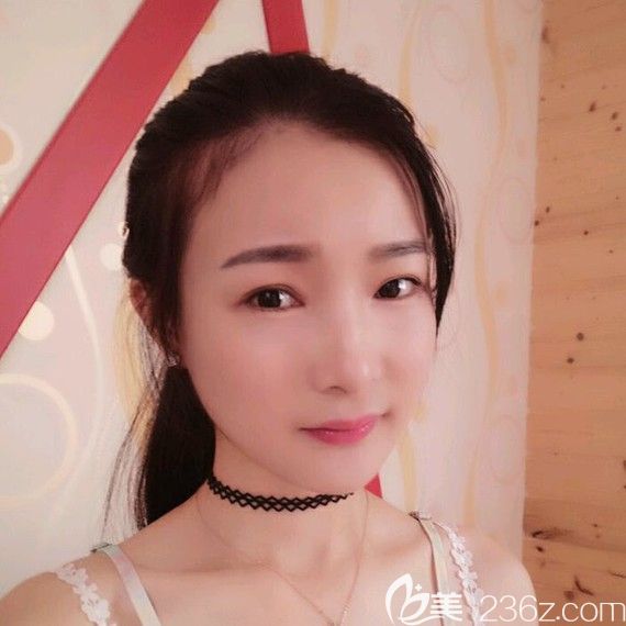 韓國佳輪韓下頜角+下巴+顴骨整形手術案例下頜角+下巴+顴骨整形案例術后效果圖 韓國佳輪韓下頜角+下巴+顴骨整形手術案例下頜角+下巴+顴骨整形案例術后效果圖