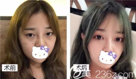 錦州斯美諾醫(yī)療美容醫(yī)院雙眼皮真人前后對(duì)比照