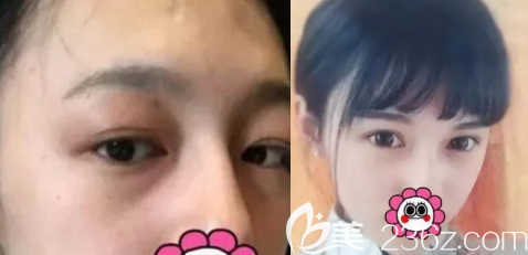 去眼袋的案例二