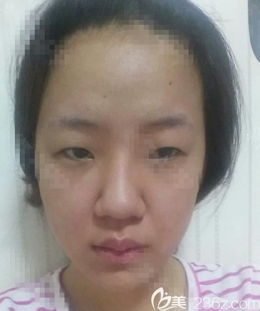 術(shù)前 術(shù)前