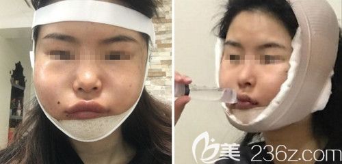 在韓國綺林做輪廓手術(shù)+面部脂肪填充手術(shù)當(dāng)天