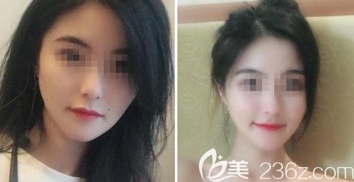 我在韓國綺林做3D顴骨+vline+面部脂肪填充后半年擺脫了我左右不對稱的臉型