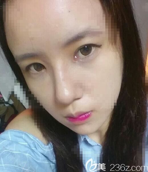 隆鼻術(shù)后2周 隆鼻術(shù)后2周