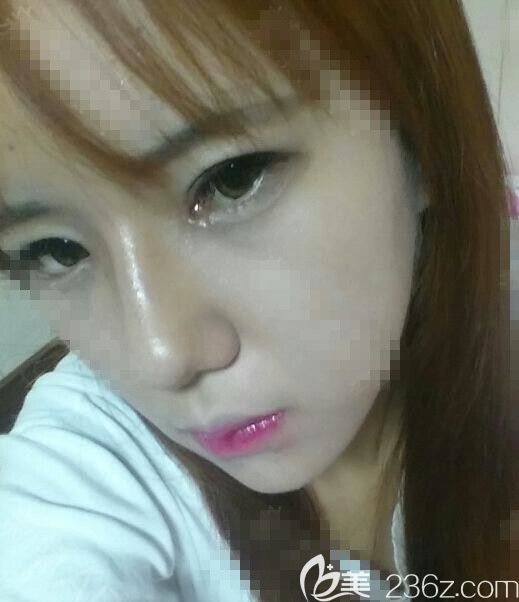 THE整形外科隆鼻真人<span style= THE整形外科隆鼻真人<span style=