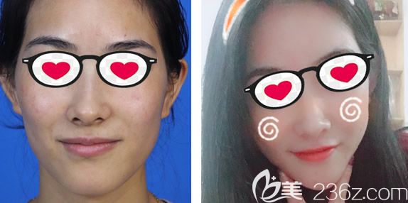 呼市京美郝維亮玻尿酸填充全臉效果怎么樣