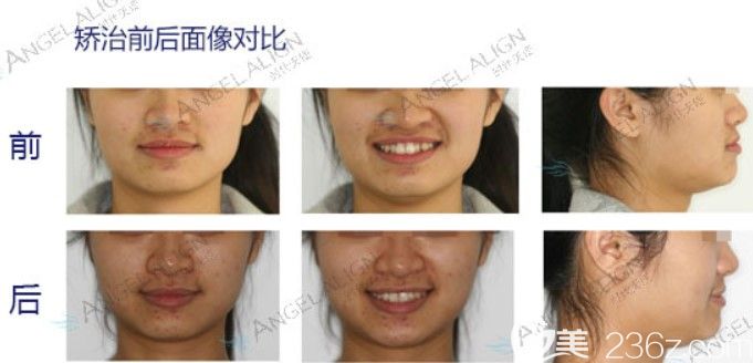 深圳拜爾口腔成人牙齒擁擠矯正后臉型變化圖