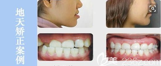 深圳拜爾口腔青少年地包天矯正臉型變化及前后對比照