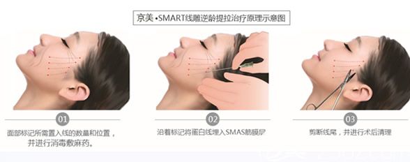 京美蛋白線提拉步驟圖解 京美蛋白線提拉步驟圖解