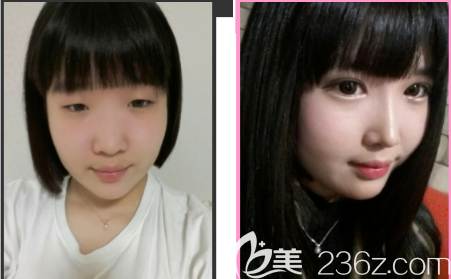 韓國(guó)卡拉美爾caramel整形外科姜宗和雙眼皮+開(kāi)眼角+上瞼下垂矯正案例 韓國(guó)卡拉美爾caramel整形外科姜宗和雙眼皮+開(kāi)眼角+上瞼下垂矯正案例