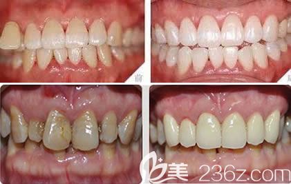 醫(yī)院口腔科黃菁牙齒美白案例 醫(yī)院口腔科黃菁牙齒美白案例