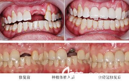 黃菁種植牙案例 黃菁種植牙案例
