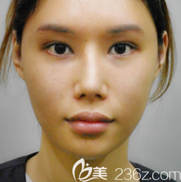 韓國POP整形醫(yī)院鼻綜合隆鼻真人案例 韓國POP整形醫(yī)院鼻綜合隆鼻真人案例