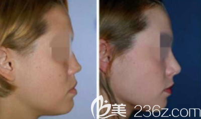 隆鼻手術(shù)案例 隆鼻手術(shù)案例