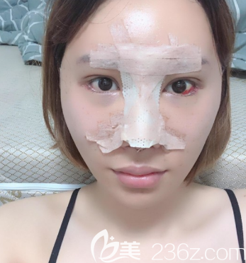 韓國POP整形醫(yī)院鼻綜合隆鼻手術真實過程 韓國POP整形醫(yī)院鼻綜合隆鼻手術真實過程