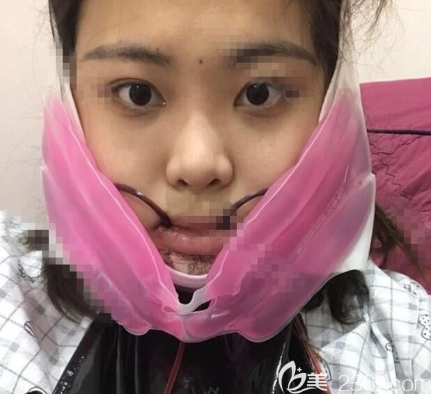 術(shù)后當(dāng)天