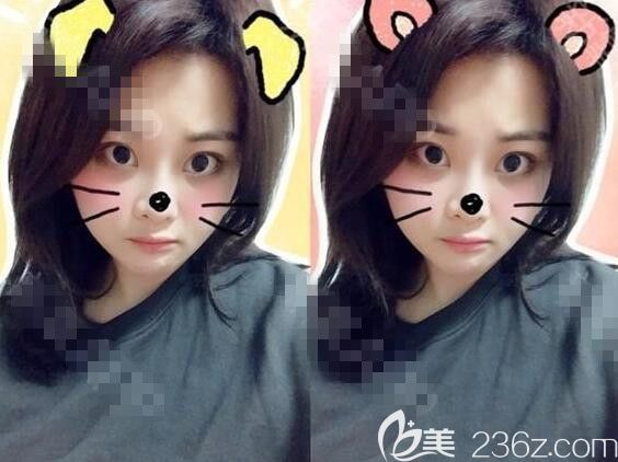 輪廓手術(shù)后一個(gè)月