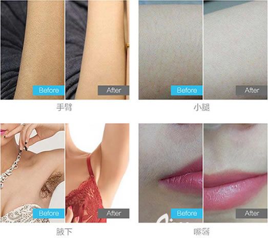 臺州愛萊美激光脫毛案例