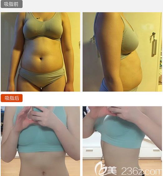 臺州愛美萊吸脂瘦身案例效果