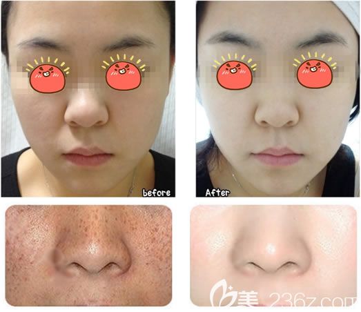 臺州愛萊美整形祛痘祛斑案例
