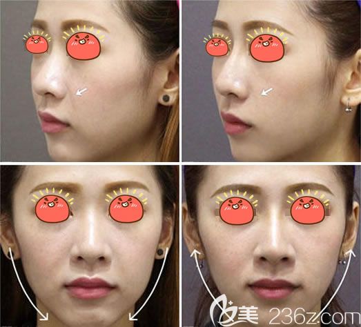 臺州愛萊美整形激光除皺案例