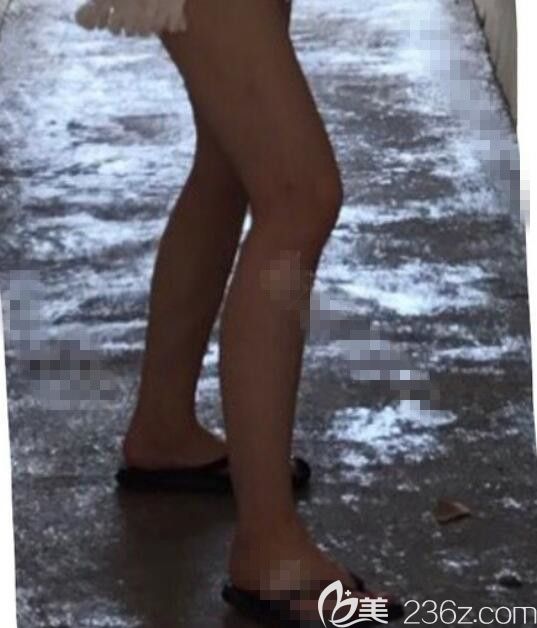 分享我在韓國勞波爾樸厚奭大腿吸脂小腿瘦臉除皺?三個月后的變化