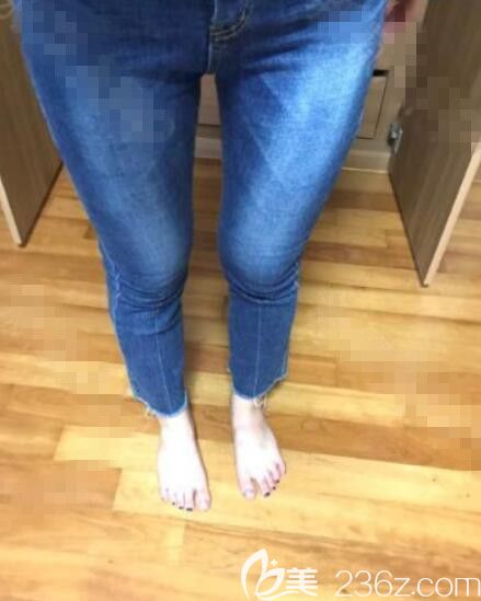 韓國勞波爾樸厚奭大腿吸脂真人案例 韓國勞波爾樸厚奭大腿吸脂真人案例