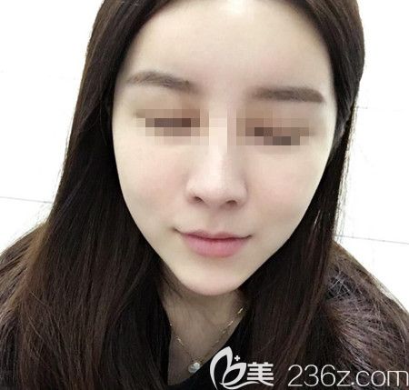 韓國拉菲安做顴骨縮小術(shù)+長曲線下頜角手術(shù)前 韓國拉菲安做顴骨縮小術(shù)+長曲線下頜角手術(shù)前