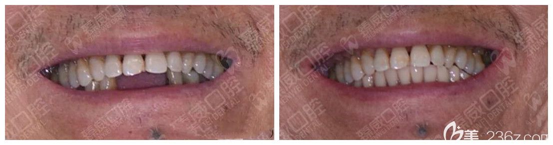 案例效果來(lái)證明<!--<i data=20240703-sp></i>-->臻威口腔好不好