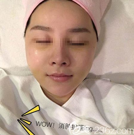 韓國拉菲安做顴骨縮小術(shù)+長曲線下頜角手術(shù)后1周 韓國拉菲安做顴骨縮小術(shù)+長曲線下頜角手術(shù)后1周