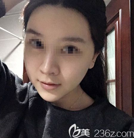 韓國拉菲安做顴骨縮小術(shù)+長曲線下頜角手術(shù)后2周 韓國拉菲安做顴骨縮小術(shù)+長曲線下頜角手術(shù)后2周