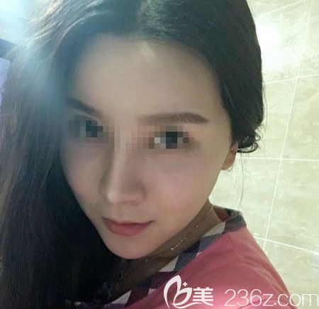 韓國拉菲安做顴骨縮小術(shù)+長曲線下頜角手術(shù)后1個月 韓國拉菲安做顴骨縮小術(shù)+長曲線下頜角手術(shù)后1個月