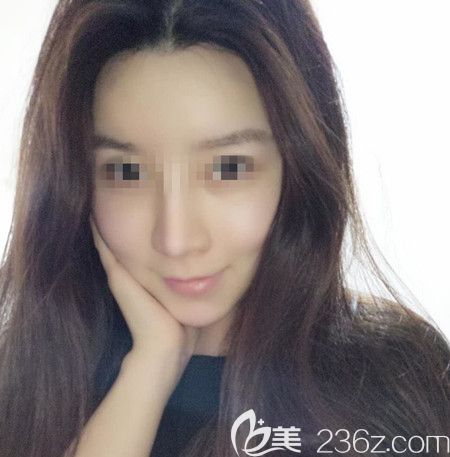 韓國拉菲安做顴骨縮小術(shù)+長曲線下頜角手術(shù)后2個月 韓國拉菲安做顴骨縮小術(shù)+長曲線下頜角手術(shù)后2個月