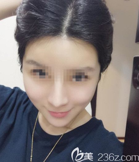 韓國拉菲安做顴骨縮小術(shù)+長曲線下頜角手術(shù)后3個月 韓國拉菲安做顴骨縮小術(shù)+長曲線下頜角手術(shù)后3個月