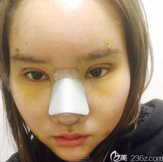 手術(shù)當(dāng)天 手術(shù)當(dāng)天