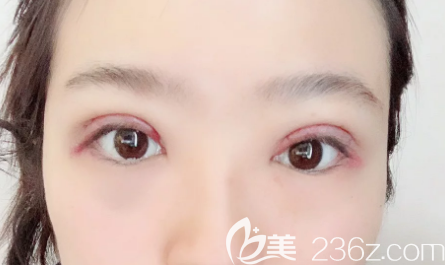 雙眼皮術(shù)后第7天 雙眼皮術(shù)后第7天