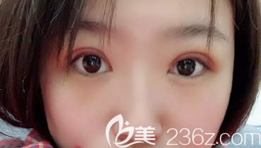 濟南寶琳娜做雙眼皮真不錯，我在濟南寶琳娜做了全切后恢復(fù)的挺快的