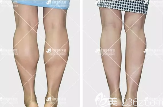 看到我在注射瘦腿前后對比圖，我覺得自己以后還是會繼續(xù)注射瘦臉除皺瘦腿的