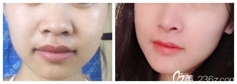 南寧美麗焦點整形焦焦俊光院長隆鼻案例