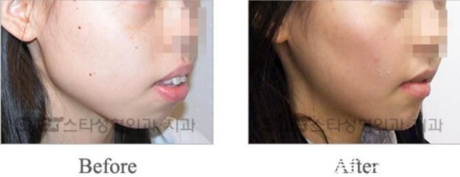 韓國明星整形醫(yī)院面部輪廓整形圖片 韓國明星整形醫(yī)院面部輪廓整形圖片