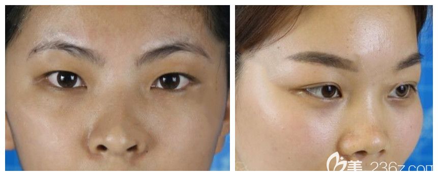 美麗焦點整形焦俊光全切雙眼皮案例