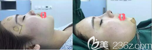 隆鼻+面部填充術(shù)后即刻對比效果