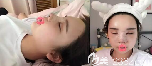 <!--<i data=20240703-sp></i>-->隆鼻術(shù)后5天正臉側(cè)臉效果