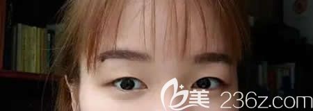 在<!--<i data=20240703-sp></i>-->醫(yī)院做雙眼皮術(shù)前照片 在<!--<i data=20240703-sp></i>-->醫(yī)院做雙眼皮術(shù)前照片