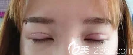 去<!--<i data=20240703-sp></i>-->醫(yī)院找史希杰院長(zhǎng)做平行雙眼皮術(shù)后即刻效果 去<!--<i data=20240703-sp></i>-->醫(yī)院找史希杰院長(zhǎng)做平行雙眼皮術(shù)后即刻效果